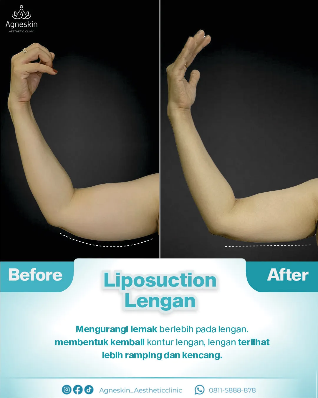 Before After Liposuction Lengan